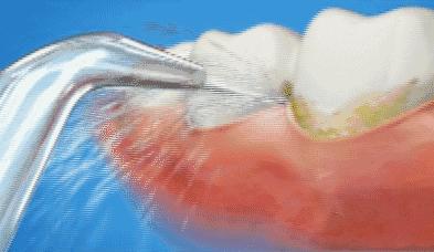 洗牙牙齿问题,医院口腔科洗牙和外面洗牙区别