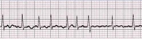 遇到急诊房颤怎么办，本文说全了！