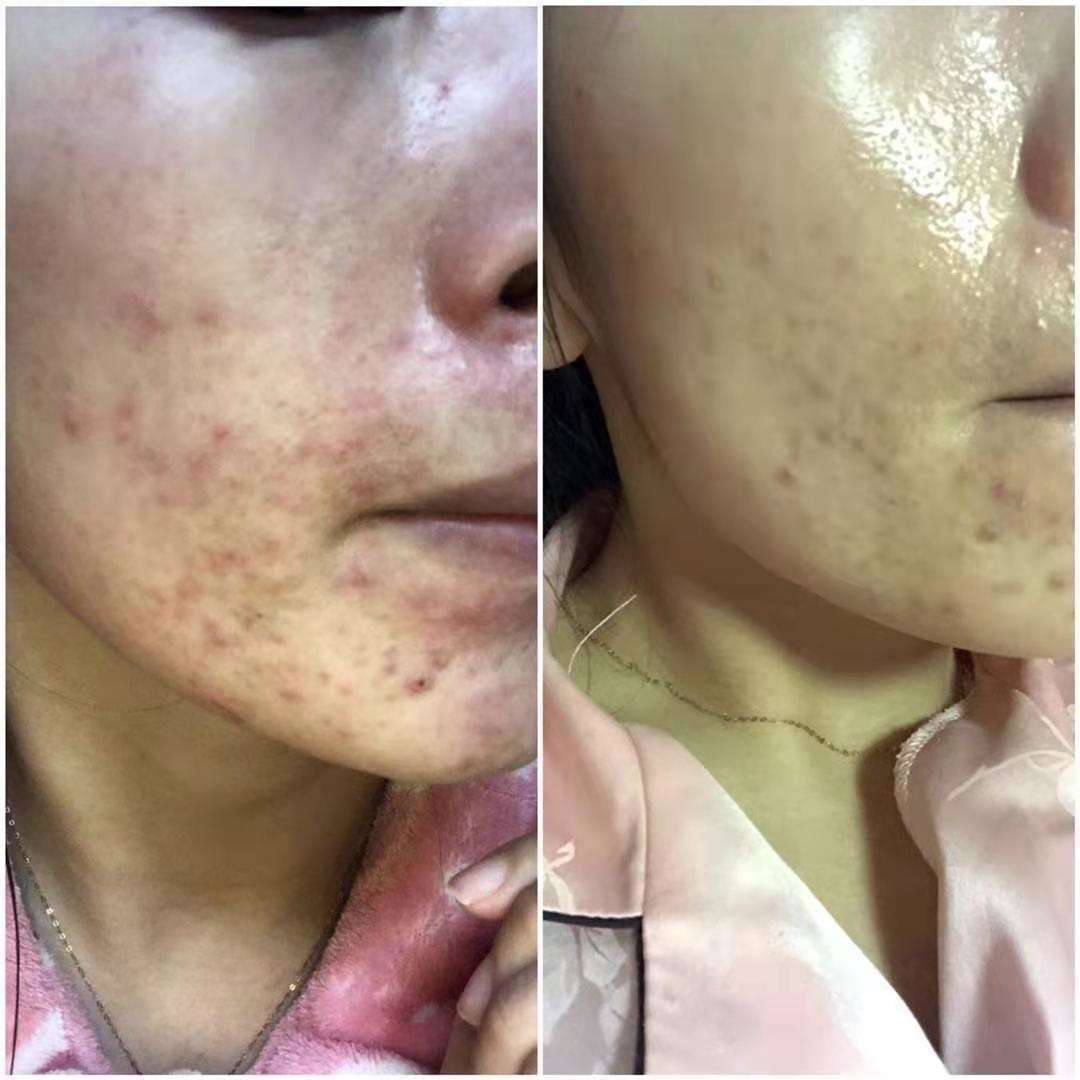 毛孔粗大是什么原因怎样改善,毛孔粗大如何改善男生洗面奶