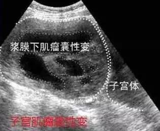 子宫肌瘤变性b超报告单会提示吗,查出子宫肌瘤囊性变怎么办