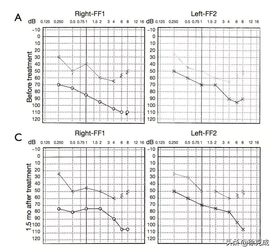 鼻咽癌放疗对大脑的影响,鼻咽癌放疗后眩晕