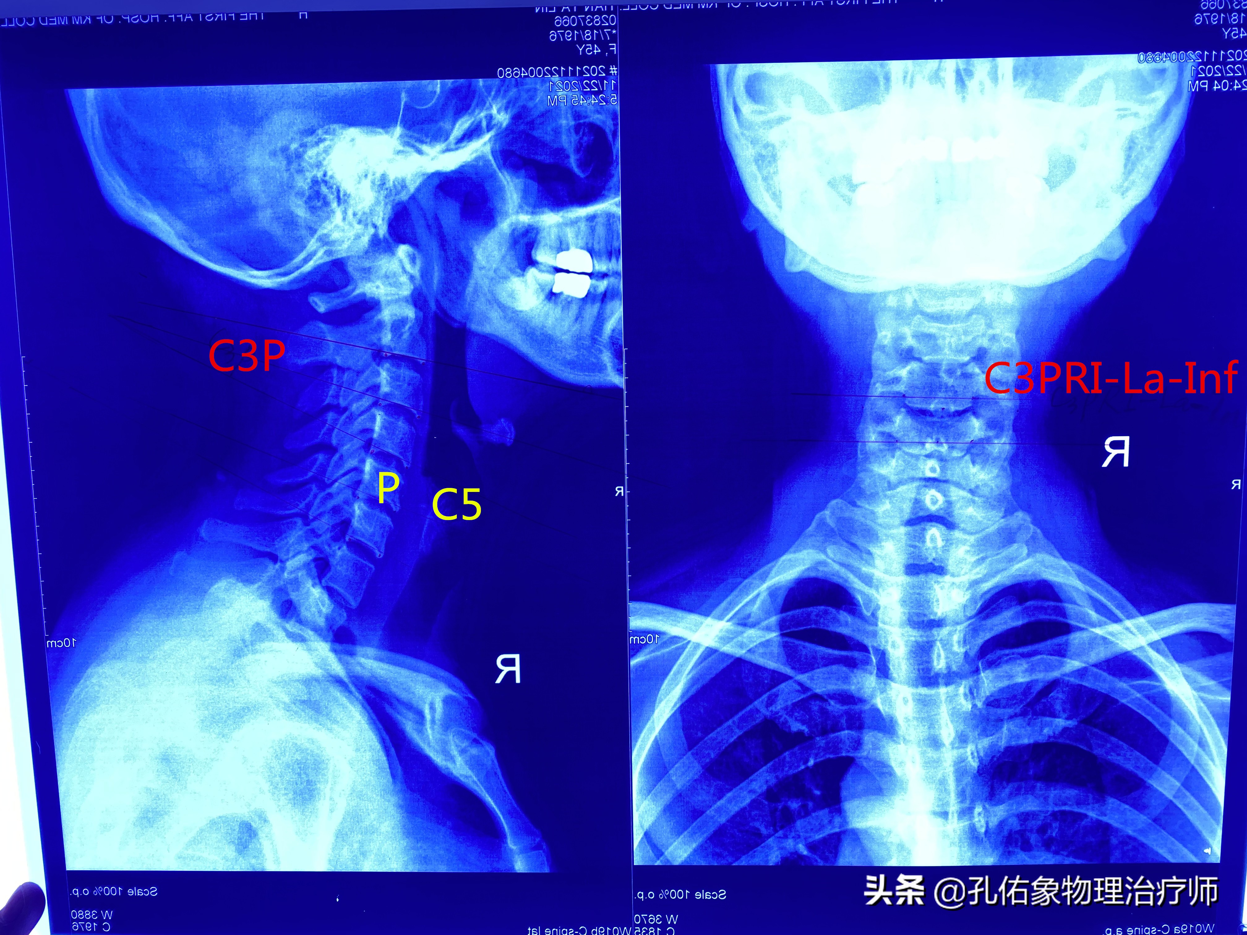 肩膀和肩胛骨疼痛如何治疗,左肩膀和肩胛骨内侧肌肉会疼