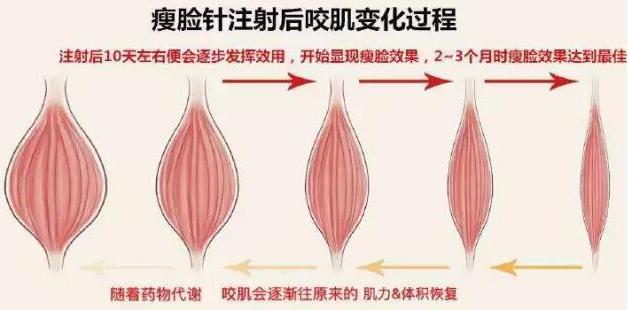 打瘦脸针3次真的可以永久定型吗,瘦脸针打三次真的能定型么