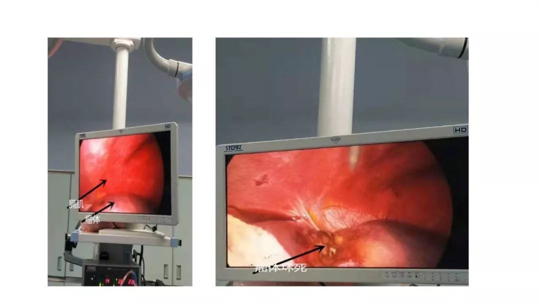 天津肝血管瘤射频消融术,肝血管瘤穿刺射频消融术