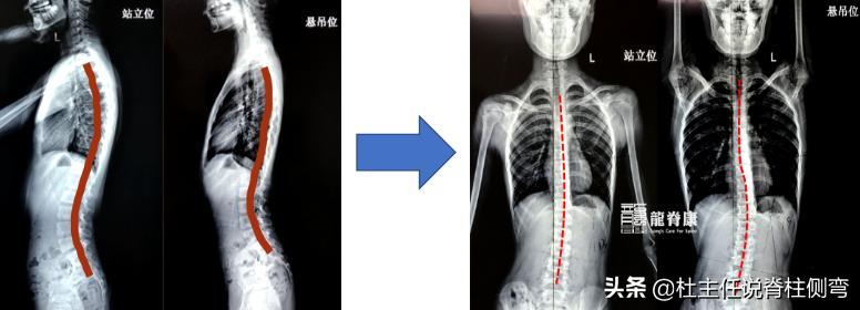 脊柱侧弯最好的恢复方法拉单杠,吊单杠可以纠正脊柱侧弯驼背吗