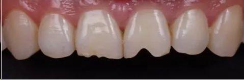 嗑瓜子把牙齿磕裂缝了怎么办,瓜子牙出现小裂痕怎么办