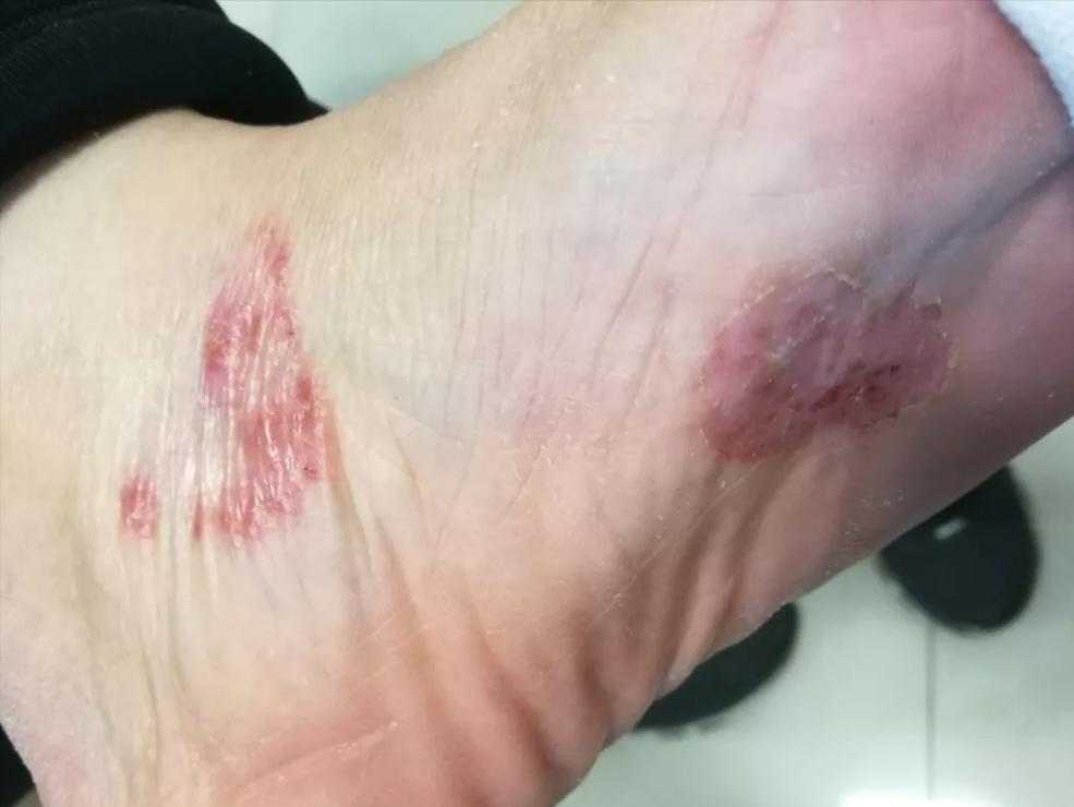 精神紧张焦虑湿疹皮炎就复发,湿疹皮炎总是复发