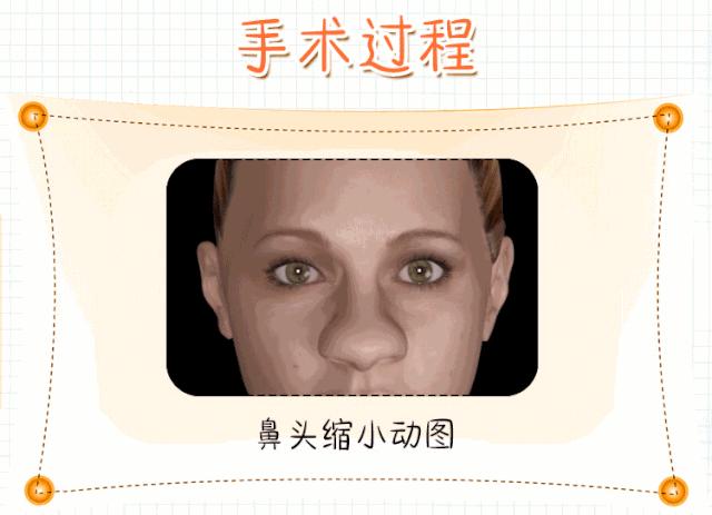 鼻子宽怎么变小一点,鼻子又宽又大怎么变小
