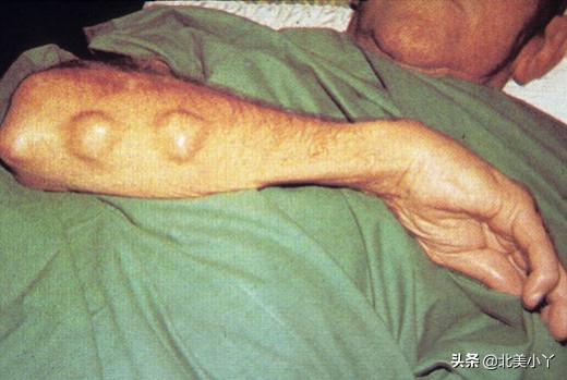 关于治疗类风湿关节炎的讲座视频,如何用药可以延缓类风湿关节炎