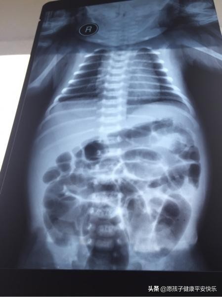 新生儿吸入性肺炎症状多久能治愈,新生儿肺炎的症状表现醒来不哭闹