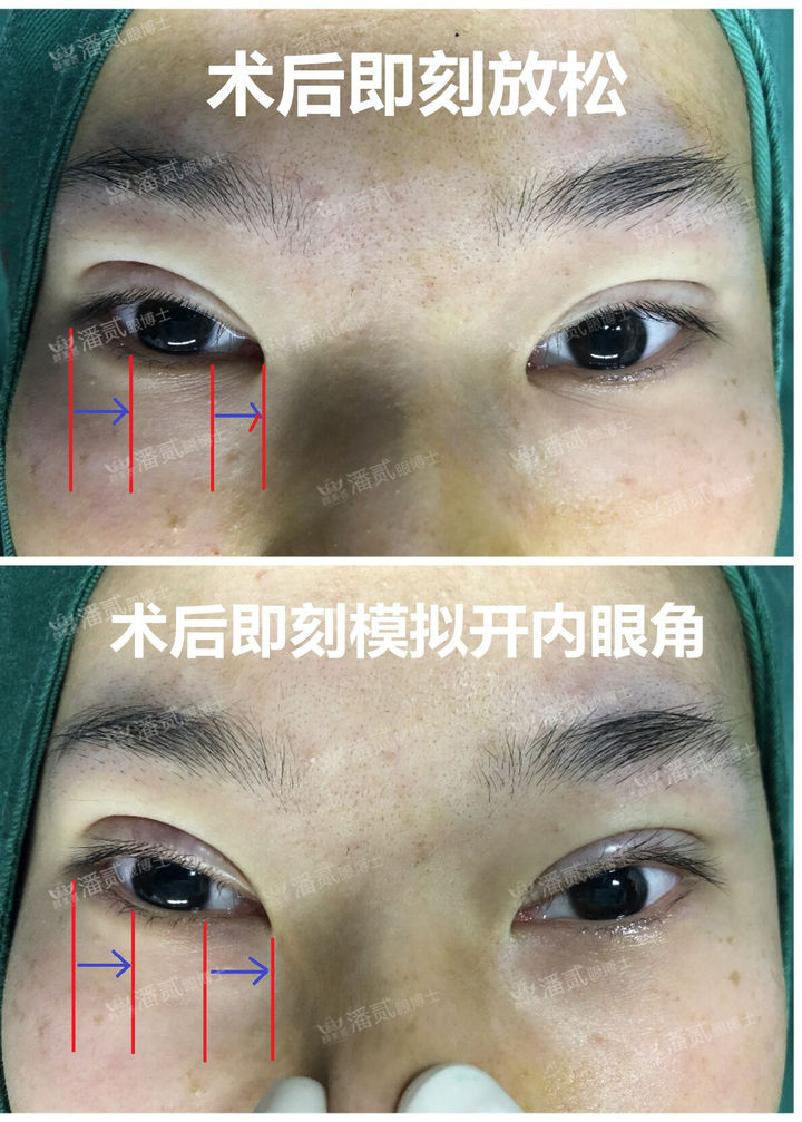 开眼角为什么分内眼角和外眼角,开眼角之后反而变丑了