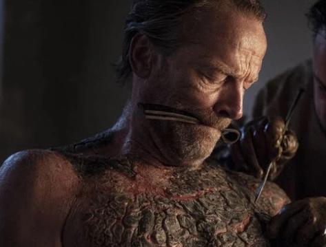 《权力的游戏》：可怕的灰鳞病