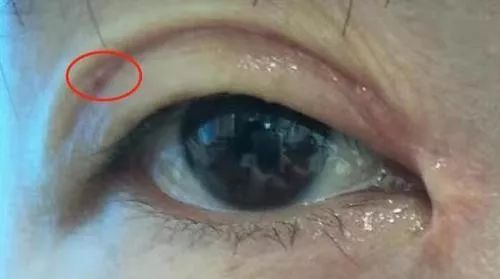 女子双眼皮整容失败,女子整容后惨不忍睹