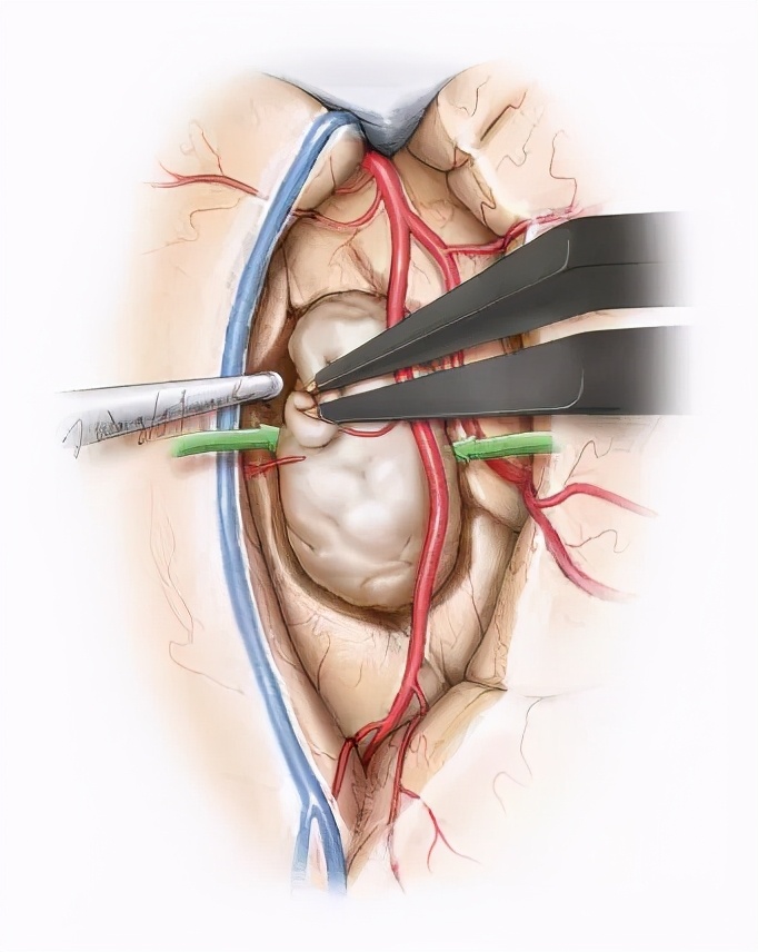 岛叶胶质瘤手术是开颅还是微创,岛叶良性胶质瘤复发率