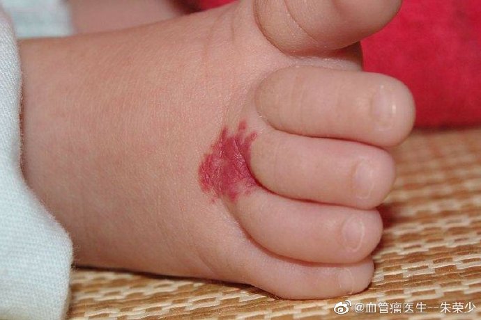 患了海绵状血管瘤，日常中需要注意什么呢？