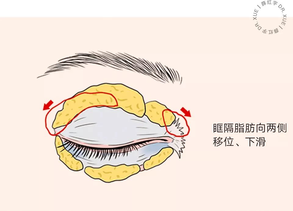 三层眼皮女人的特点,哪种眼皮最好看