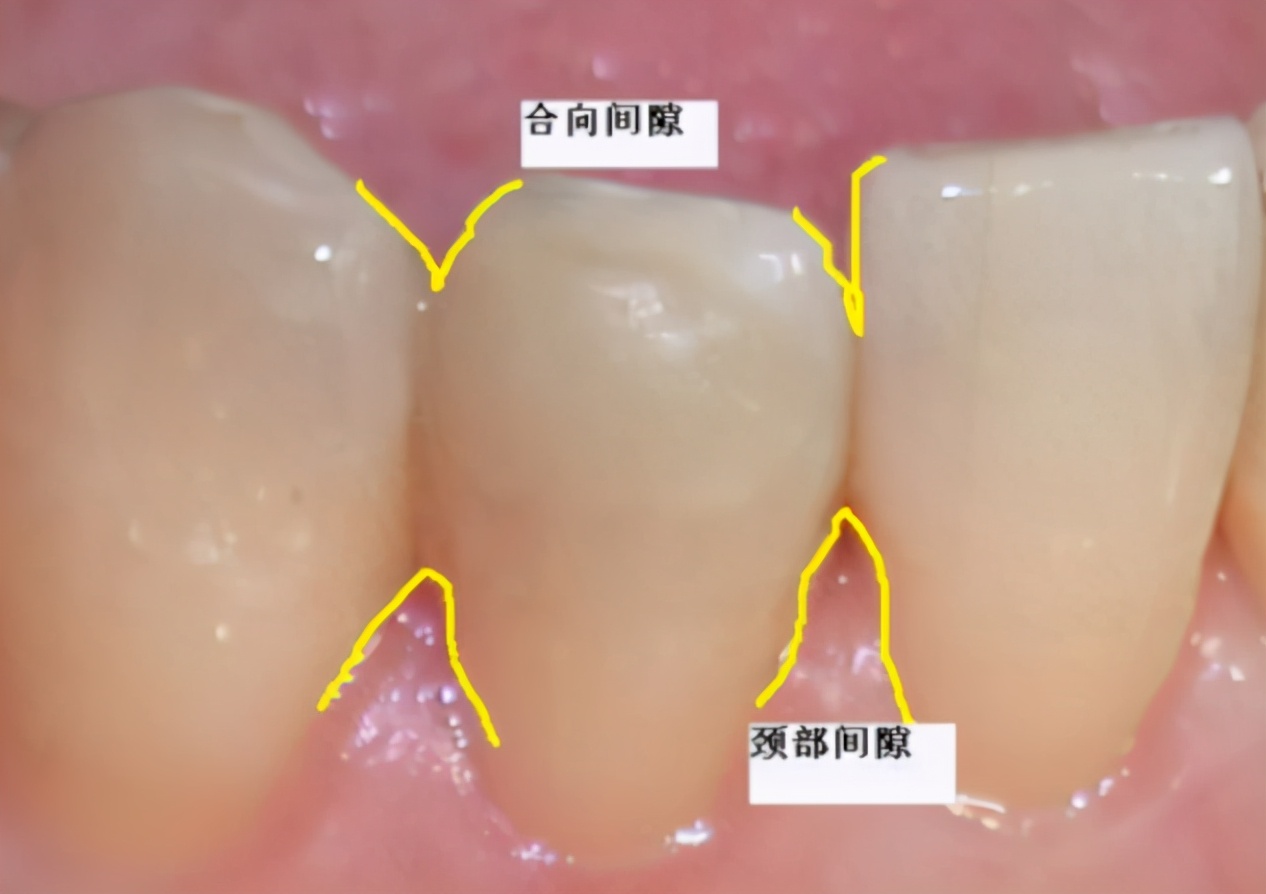 牙齿为什么会黑三角,牙齿出现黑三角是为什么