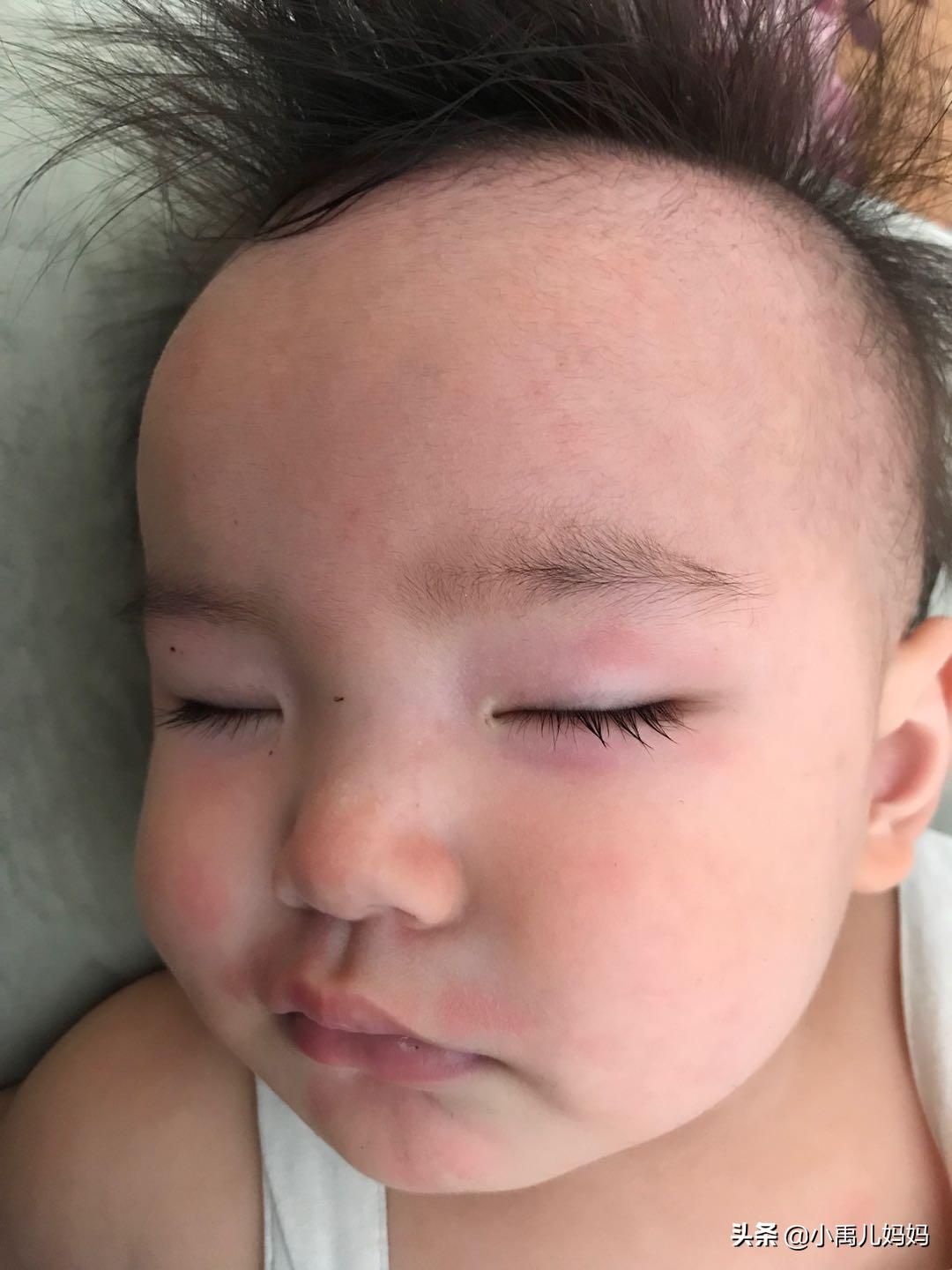 牛奶鸡蛋小麦过敏要注意什么,牛奶蛋白过敏宝宝可以吃什么辅食