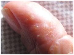 宝宝手指脱皮严重用什么药膏,手指脱皮抹什么药膏