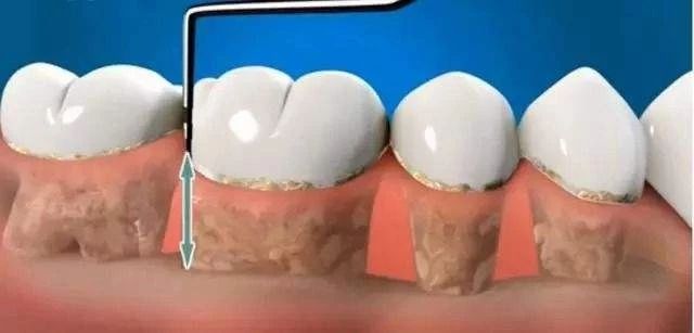 得了牙周炎的人最多能活多久,得了侵袭性牙周炎最多撑多久