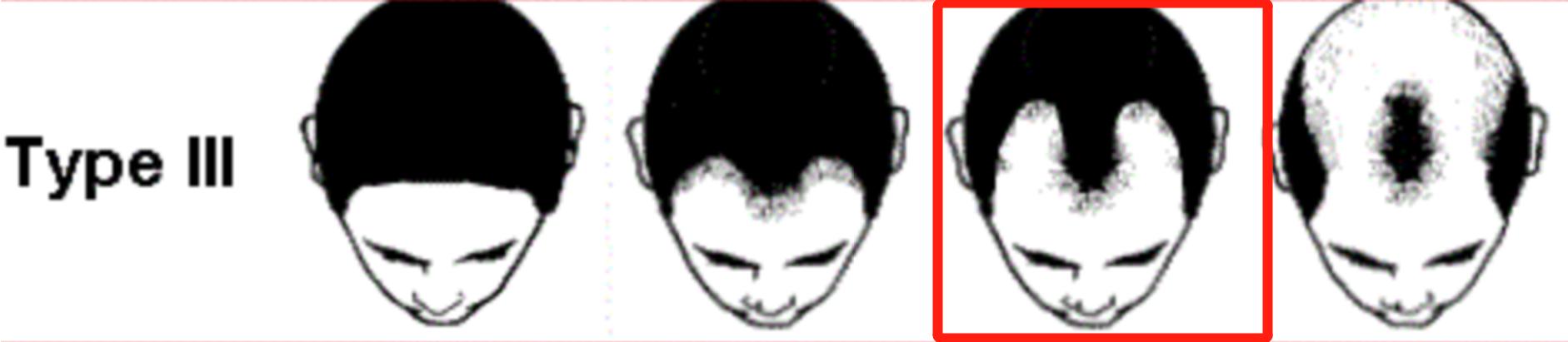 裘德洛的秃头适合什么发型,裘德洛秃顶