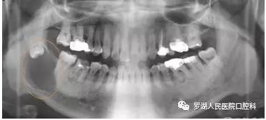 不想拔智齿但很疼怎么办,不想拔智齿想磨掉一部分怎么样