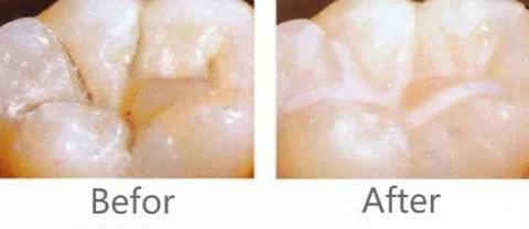 什么是儿童窝沟封闭？会不会痛？1分钟视频带你看懂#雅悦齿科#