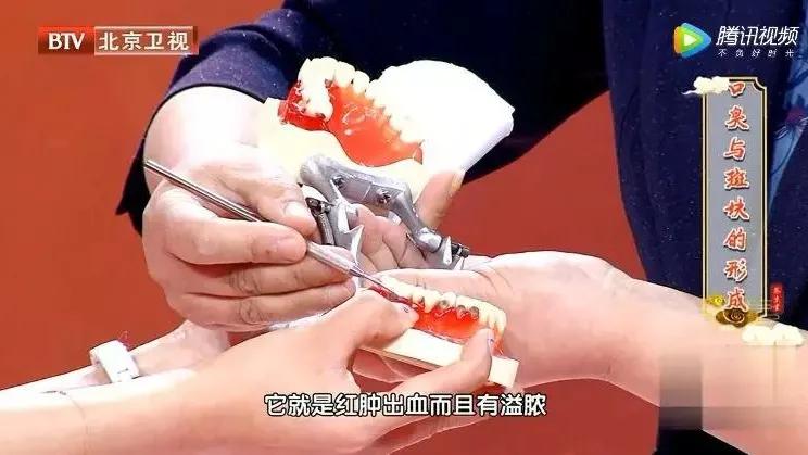 吃饭老塞牙缝怎么治疗,吃饭总塞牙你知道问题出在哪里吗