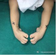 马蹄内翻足孩子的康复,成人马蹄足内翻康复治疗