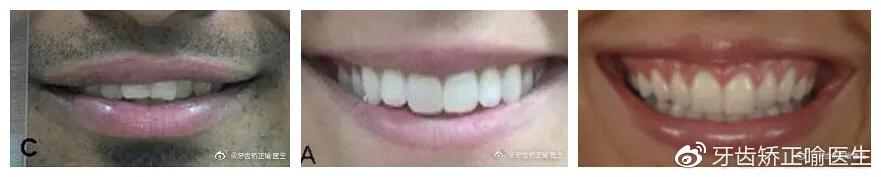 笑起来露牙龈怎么解决,笑露牙龈矫正大概得要多少钱