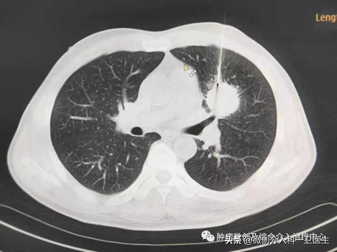 运城市第一医院肿瘤微创及综合介入科，特色技术—肿瘤穿刺活检术