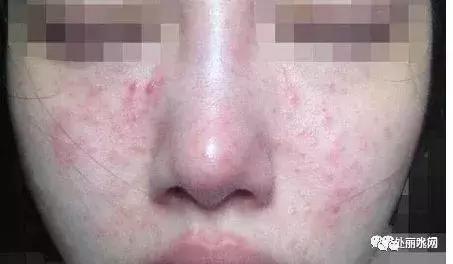 仅用了4天，丽水姑娘皮肤出现永久性损伤！购买这东西一定要谨慎