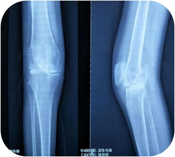 小针刀帮大忙，畸形3年伸不直的膝盖终有治