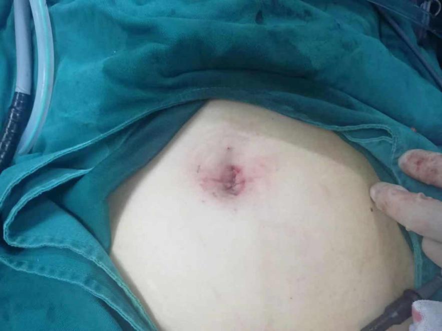 腹腔镜切除多发性子宫肌瘤,新型微创腹腔镜子宫肌瘤剔除术