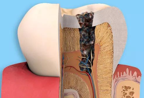 蛀牙不是很严重需要补吗,蛀牙不严重要做根管治疗吗