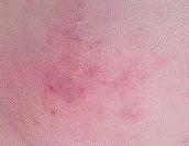 分享祛痘过程博主,分享自己治疗痘痘的经历