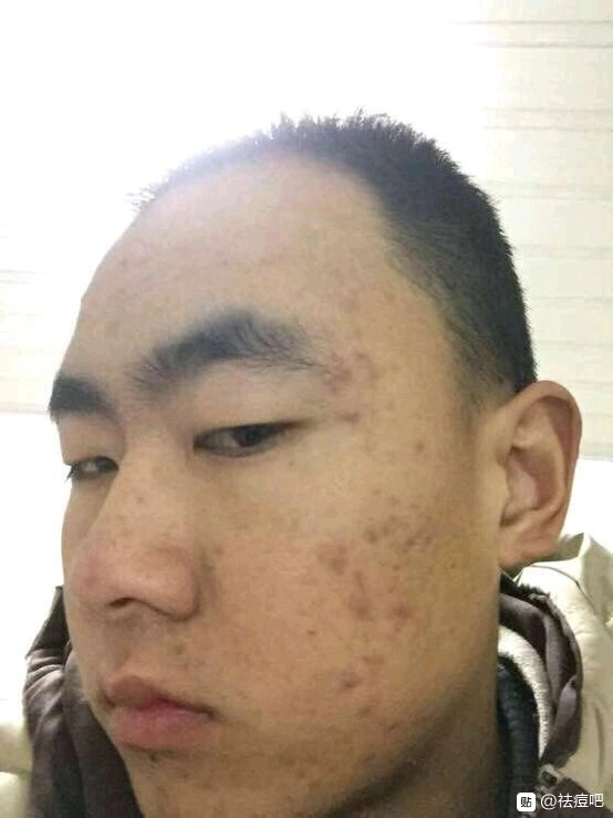 祛痘治疗后恢复,祛痘可以治好痘痘吗