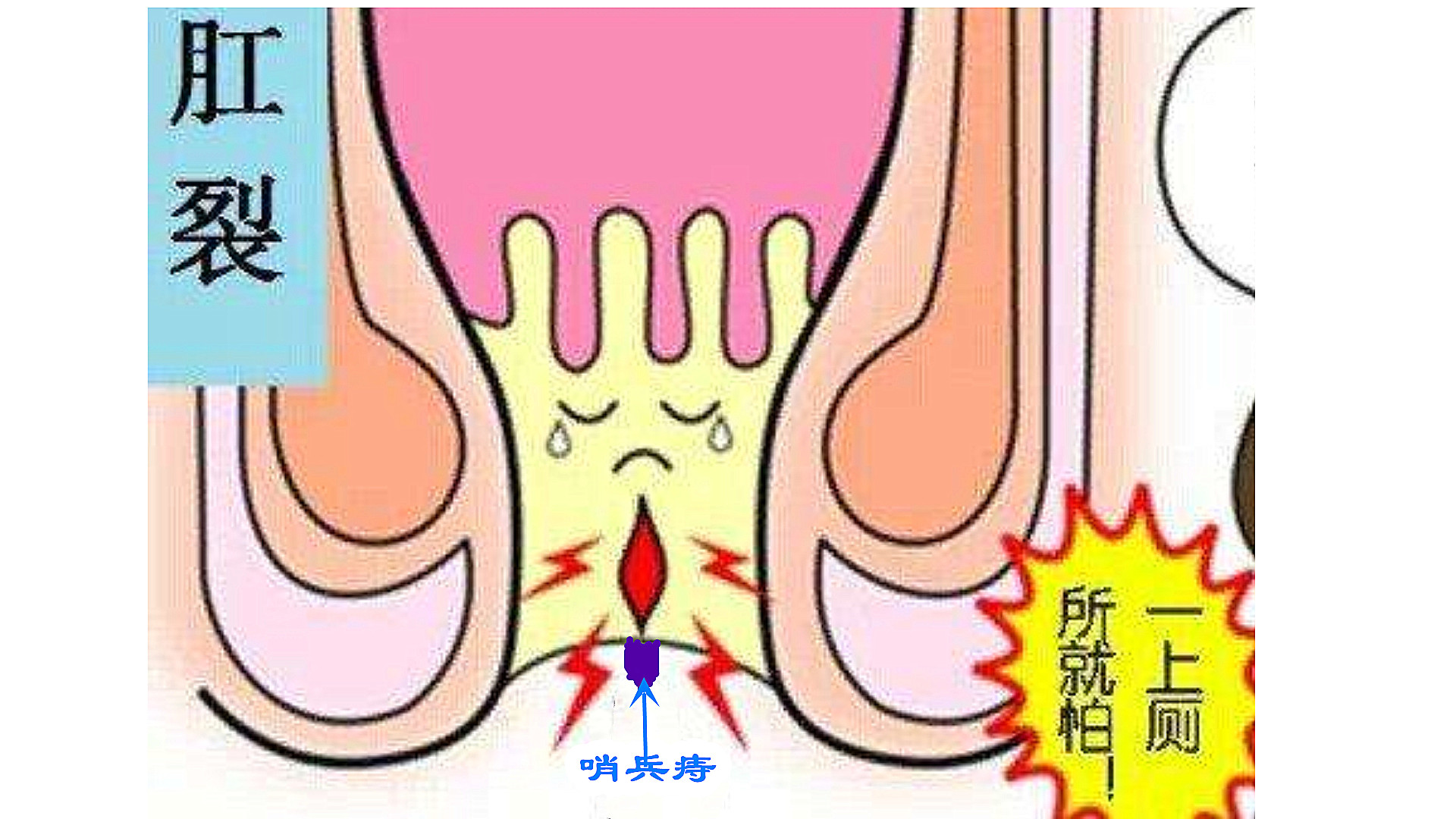 不公平!“痔疮”说:凭什么“肛裂”的锅要由我来背呢