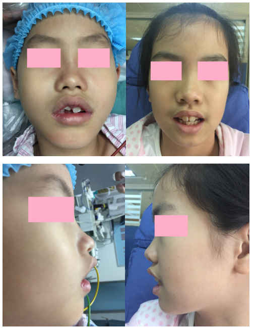 多动症抽动症的治疗方法,中医对多动症的认识