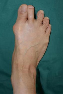 拇外翻全国足踝外科顶级专家,精细化手术