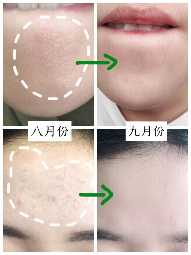 韩国女生天天吃泡面靠吃维生素,在韩国吃泡面会让皮肤变差吗