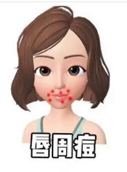 鼻翼两侧和下巴长痘什么原因引起,脸颊两边长痘是什么原因该怎么办