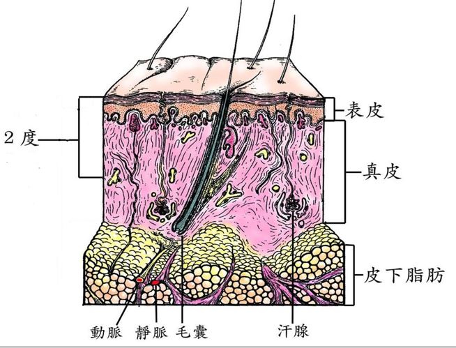 孩子烫伤记住5个字,牢记五字口诀轻松处理宝宝烫伤