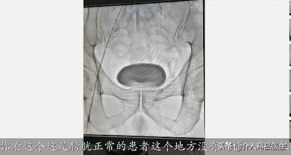 医生给你用图片讲解：前列腺增生如何微创治疗，一看就懂！