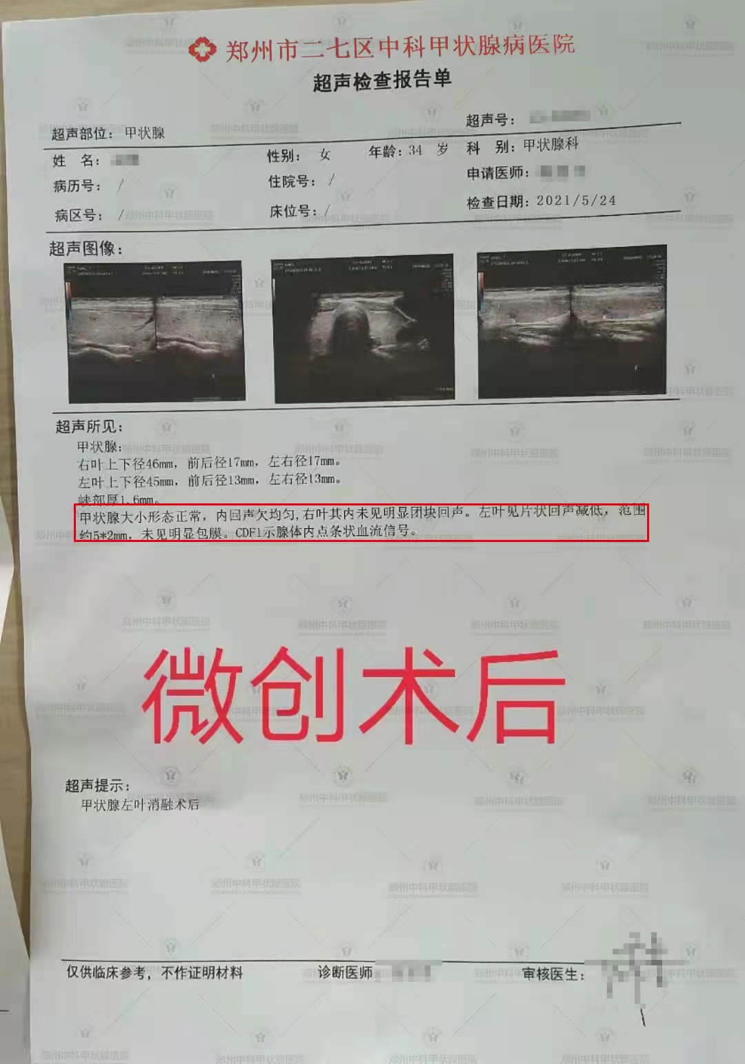 甲状腺结节心慌发热失眠,甲状腺手术成功案例