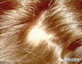 斑秃饮食食谱一览表,斑秃须注意饮食调理