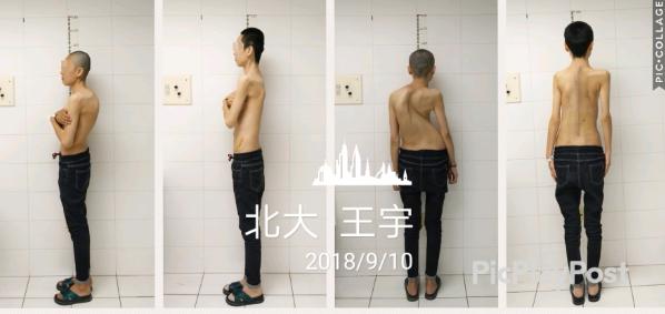 脊柱侧弯手术费要多少,脊柱侧弯的手术费用是多少呢