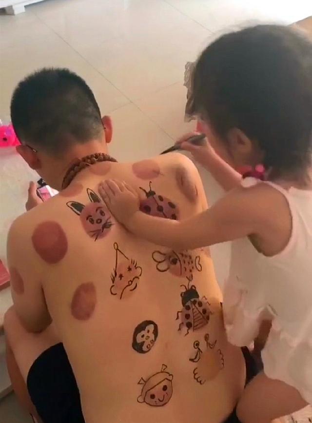 爸爸拔罐留下的印子,爸爸拔火罐后续