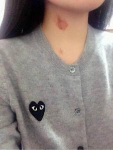 家长发现草莓印怎么办,女儿脖子上有红痕家长该怎么引导