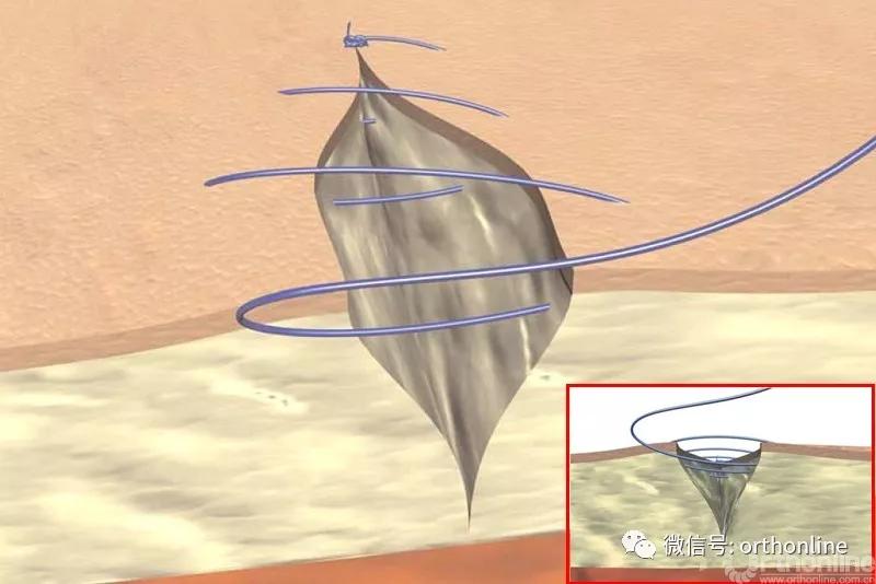 十种外科基本缝合方式详解,手术切口缝合有哪几种